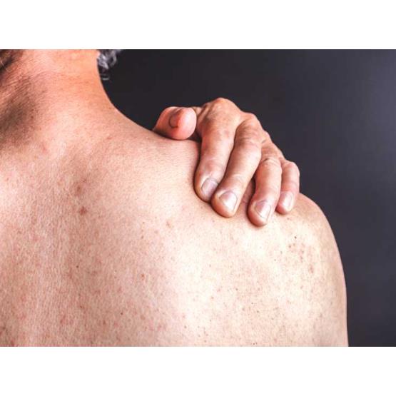Psoriasis